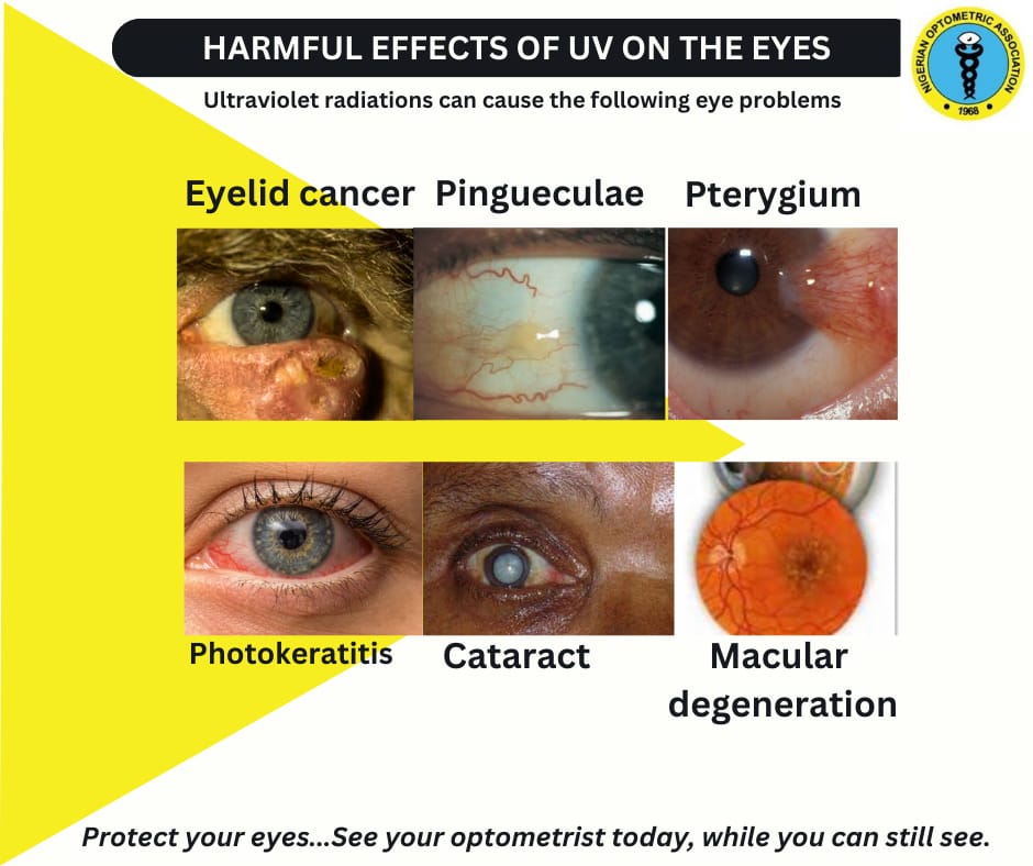 Harmful Effects of UV on the Eyes: A Guide by the Nigerian Optometric Association, Lagos State Chapter
